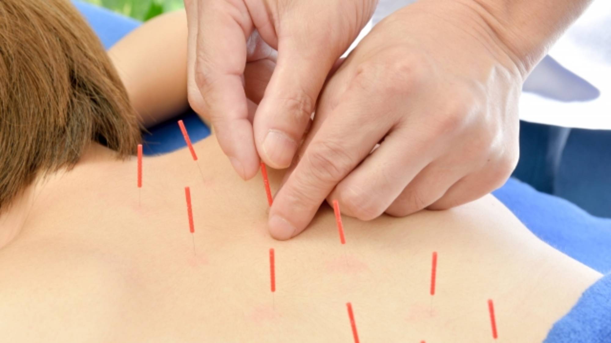 ・【オプション】鍼灸